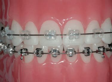 brackets de zafiro y metalicos|brackets de zafiro precio.